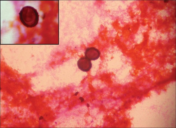Личинка аскариды в крови при анализе