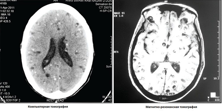 Цистицеркоз мозга на МРТ и КТ