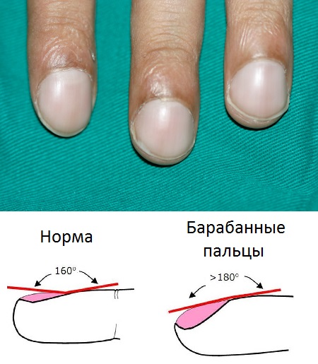 Симптом барабанных пальцев при трихоцефалезе