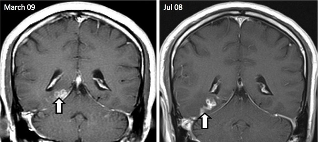 Церебральный спарганоз, показанный на снимках головного мозга