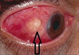 Узелок в глазу при дирофиляриозе