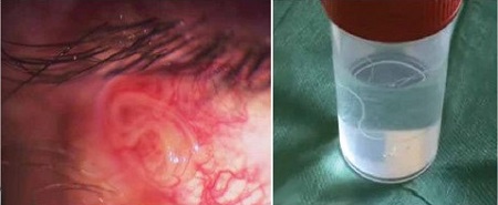 Дирофилярия в глазу и после извличения