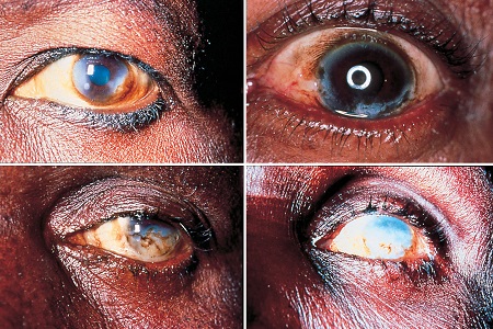 Процесс потери зрения при онхоцеркозе